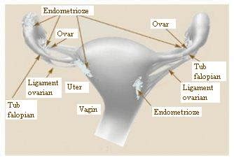 noduli varicoși ai uterului